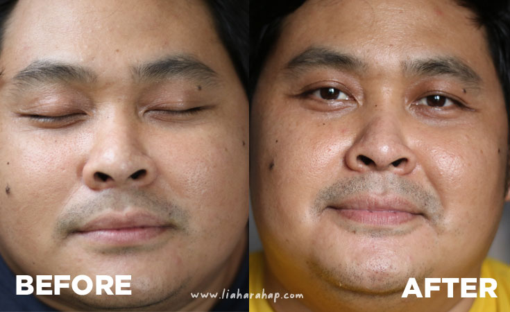 before-after skincare